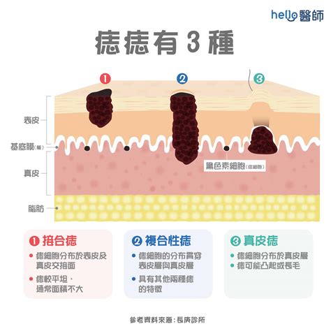 臉頰長痣|痣形成的原因？痣長毛、痣變多變大是痣病變？5招判別